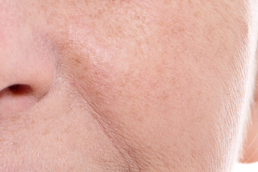 Nahaufnahme Nasenlippenfurchen