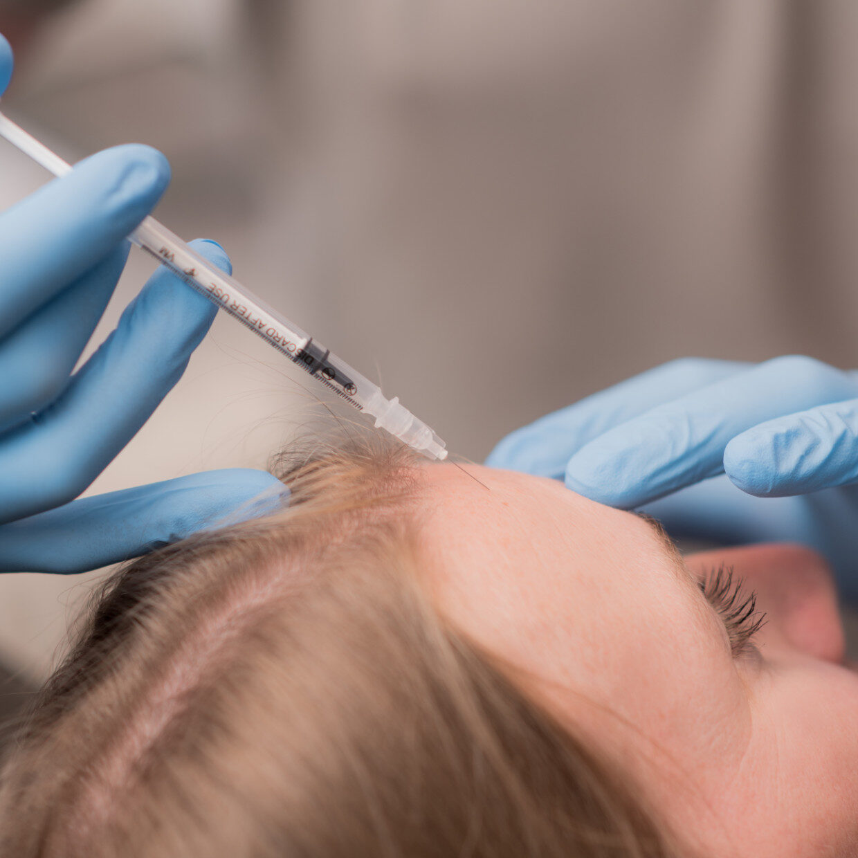 Nahaufnahme Unterspritzung an der Stirn einer Patientin