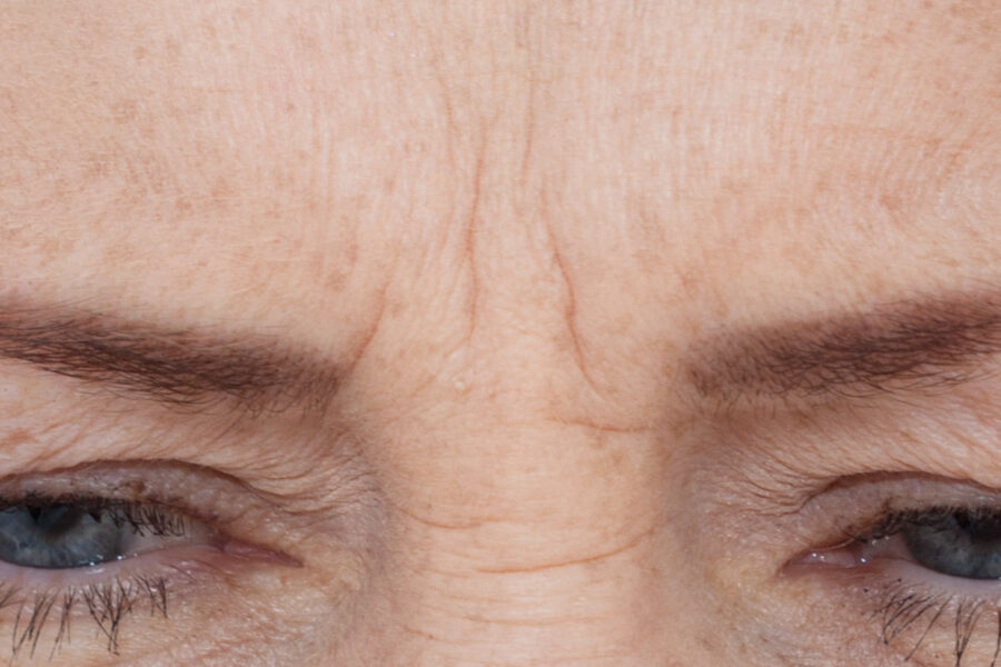 Nahaufnahme Zornesfalten